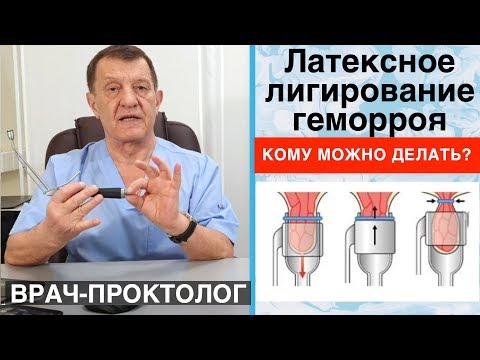 Видео: ЛАТЕКСНОЕ ЛИГИРОВАНИЕ ГЕМОРРОЯ - Кому можно делать?