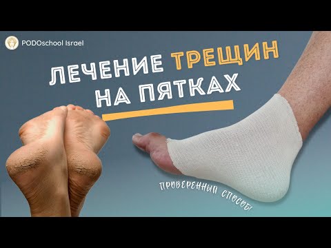 Видео: Как лечить трещины на пятках (окклюзионная повязка)