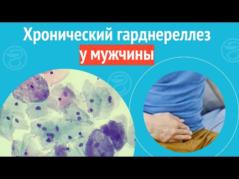 Видео: 👨‍🦲 Хронический гарднереллез у мужчины. Клинический случай №1409