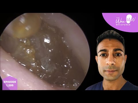 Видео: 1285 видео об удалении ушной серы