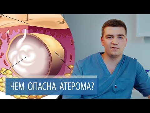 Видео: ЧЕМ ОПАСНА АТЕРОМА? | Лечение жировика атеромы