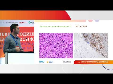 Видео: Тумори, асоциирани с епилепсия - в контекста на фокална кортикална дисплазия тип IIIb, д-р Митков