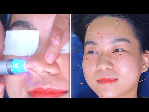 Видео: ASMR  Очищение пор | Косметическая акупунктура для придания коже упругости