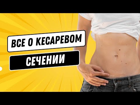 Видео: Все о кесаревом сечении @DrOlenaB