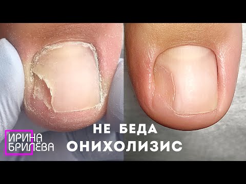 Видео: Педикюр БЕЗ ПАНИКИ!!! 😱 Онихолизис - это не страшно 🌸 КАК ОТРАСТИТЬ новый и здоровый ноготь