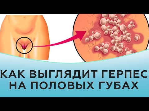 Видео: Как выглядит герпес на половых губах