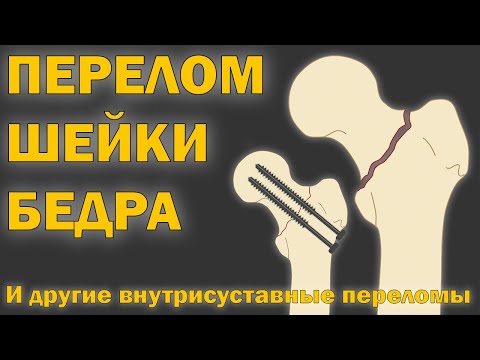 Видео: Перелом шейки бедра, мыщелковый перелом, перелом локтя, частичное протезирование [S05E16]