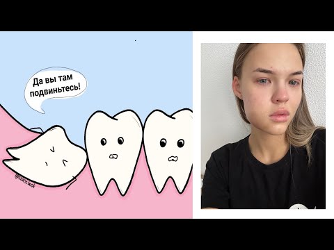 Видео: ВСЁ О ЗУБАХ МУДРОСТИ| УДАЛЕНИЕ| МОЙ СЛУЧАЙ