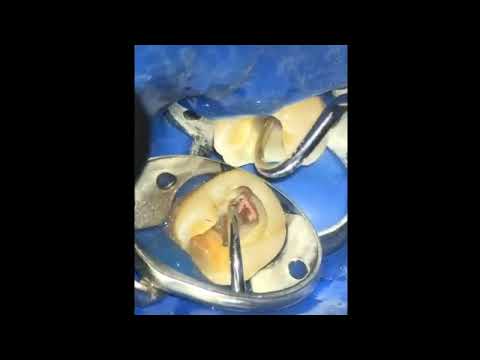 Видео: 2021-02-04 Биокерамика или эпоксидка пиво или рыба, можно ли активировать хлорку каналонаполнителем,