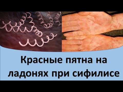 Видео: Красные пятна на ладонях при сифилисе.
