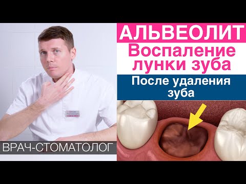 Видео: Альвеолит - воспаление лунки зуба после удаления зуба. Причины, симптомы, лечение альвеолита