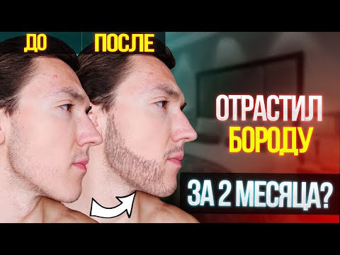 Видео: КАК ОТРАСТИТЬ БОРОДУ С ПОМОЩЬЮ МИНОКСИДИЛА? КАК ИСПОЛЬЗОВАТЬ МИНОКС.