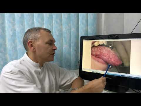 Видео: Стоматологи против пирсинга языка  и тд.!