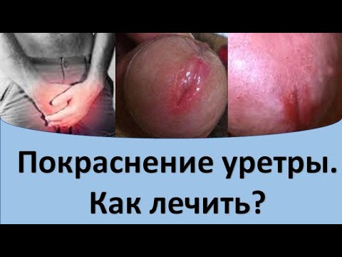 Видео: Покраснение уретры  Как лечить?
