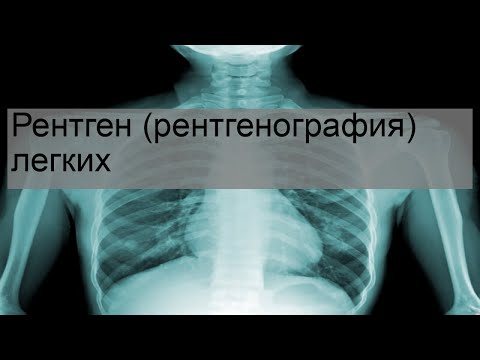 Видео: Рентген (рентгенография) легких