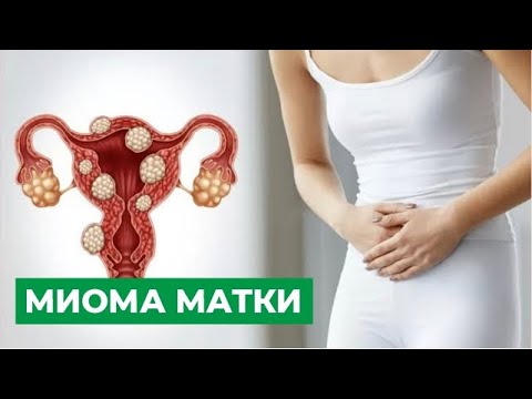 Видео: Миома матки: причины, симптомы. Лечение миомы матки.