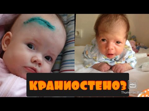 Видео: КРАНИОСТЕНОЗ (КРАНИОСИНОСТОЗ). НАША ИСТОРИЯ