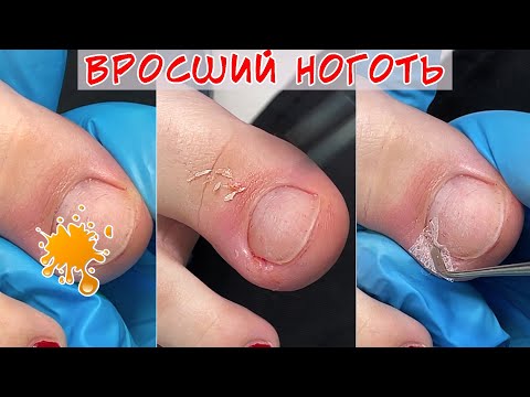 Видео: Гной под ногтем 😨 Вросший ноготь