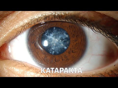 Видео: Катаракта. PROЗРЕНИЕ @doctorchannel