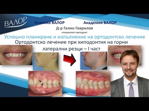 Видео: Хиподонтия на горни латерални резци. Заместване на липсващите зъби със съседните, без протезиране.