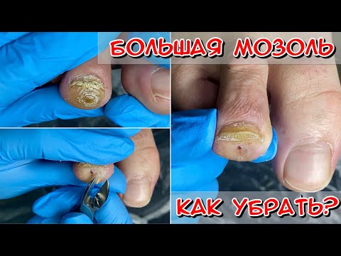 Видео: Огромная мозоль / мозоль на пальце ноги / Мозоль как убрать