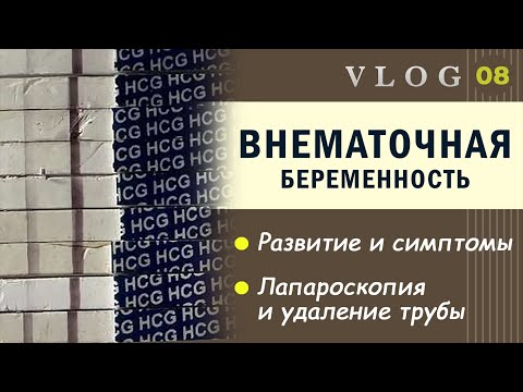 Видео: ЭКО. Внематочная беременность после ЭКО // Развитие и признаки // Лапароскопия