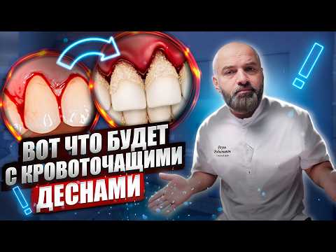 Видео: Кровоточивость Десен. САМЫЙ надежный СПОСОБ вылечить ГИНГИВИТ и ПАРОДОНТИТ