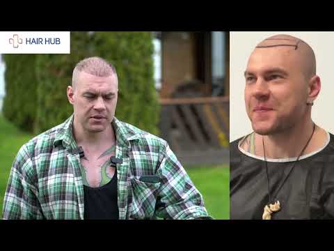 Видео: Пересадка волос