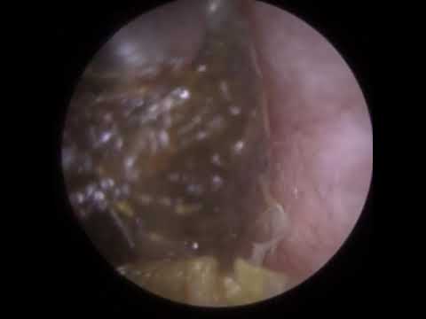 Видео: 778 — самое обильное удаление ушной серы на сегодняшний день!