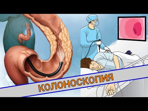 Видео: КОЛОНОСКОПИЯ || ЧТО ЭТО? КАК ПОДГОТОВИТЬСЯ?