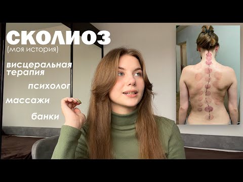 Видео: моя история. сколиоз.