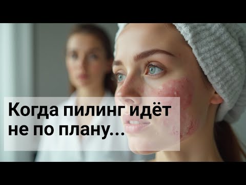 Видео: Химический пилинг: когда результат - ожог