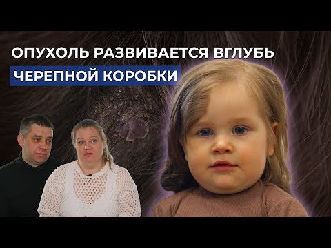 Видео: НЕВУС ВОЛОСИСТОЙ ЧАСТИ ГОЛОВЫ | История Ксюши Голубёнковой