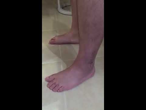 Видео: Бималеоларна фрактура- комплекс за равновесие