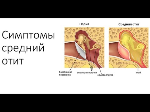 Видео: Отит симптомы. Какие симптомы мы наблюдаем при средних отитах.