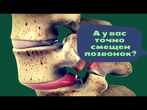Видео: Нестабильность позвоночника. Что нужно знать о правке