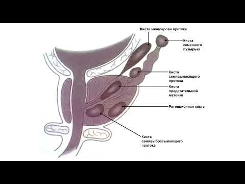 Видео: Ультразвуковая диагностика. Доктор Иогансен. Видеопримеры. Выпуск 81. Кисты предстательной железы.