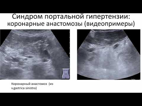 Видео: Эхосемиотика диффузных изменений печени. Часть 2.  Цирроз печени и портальная гипертензия