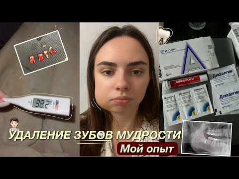Видео: УДАЛЕНИЕ ЗУБОВ МУДРОСТИ| МОЙ ОПЫТ | НЕДЕЛЯ ВОССТАНОВЛЕНИЯ