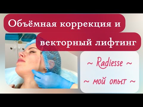 Видео: Заполнение объёма щёк и скул, подтяжка лица - РАДИЕС (Radiesse). Процедура и результат, мой отзыв