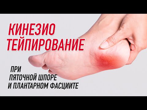 Видео: ✅ КИНЕЗИОТЕЙПИРОВАНИЕ ПРИ ПЯТОЧНОЙ ШПОРЕ | Сания Абдрахманова | Учебный центр BBALANCE