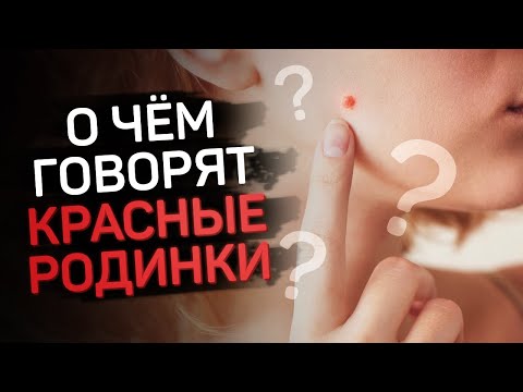 Видео: Что значат красные родинки на теле?