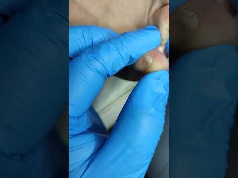 Видео: Межпльцевая мозоль
