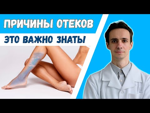 Видео: ПОЧЕМУ ОТЕКАЮТ НОГИ? Асцит. Болезни сердца. Недостаток белка....