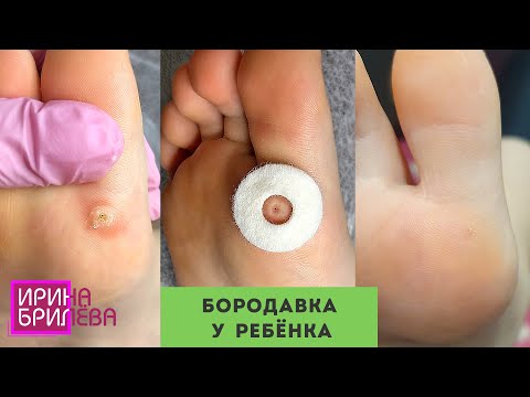Видео: Убираем БОРОДАВКУ у ребёнка 🌸 ПЕДИКЮР 🌸 Ирина Брилёва