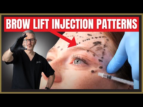 Видео: Схемы инъекций ботокса для подтяжки бровей. Учебник по разметке ботокса.