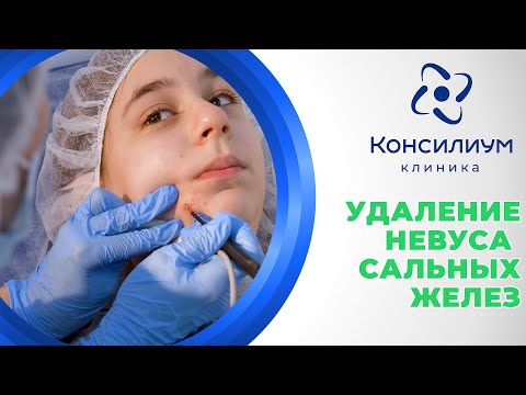Видео: Удаление невуса сальных желез