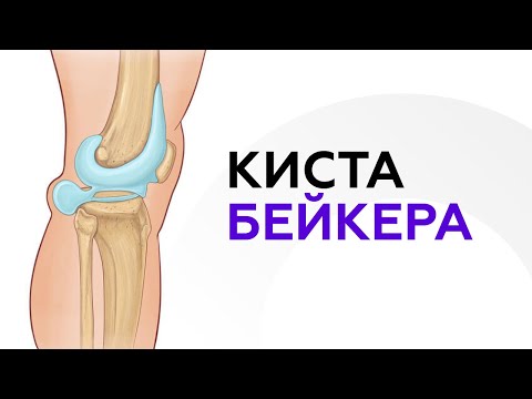 Видео: Врач-ортопед Мусин У.К. про кисту Бейкера