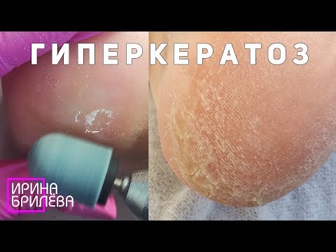 Видео: ГИПЕРКЕРАТОЗ 🍀 Обрабатываем огрубевшие участки кожи 🍀 Комбинированный ПЕДИКЮР