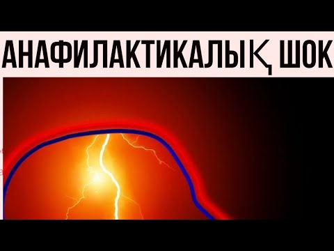 Видео: Анафилактикалық шоқ. Анафилактический шок. Анафилаксия. Аллергия. Квинке ісігі. Реакция.